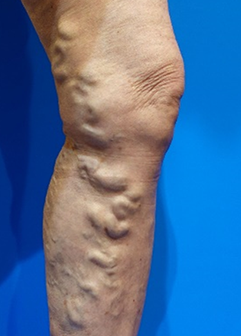 Varicose veins