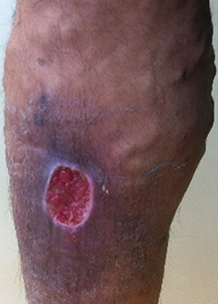 Skin ulcer