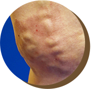 varicose veins